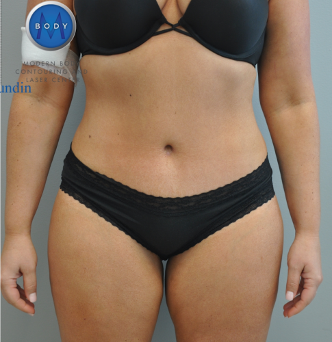 Tummy Tuck Before and After | Little Lipo