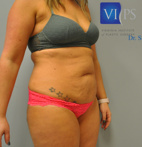 Tummy Tuck Before and After | Little Lipo