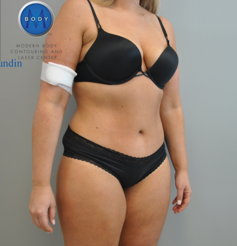 Tummy Tuck Before and After | Little Lipo