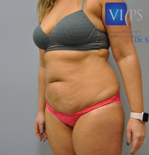 Tummy Tuck Before and After | Little Lipo