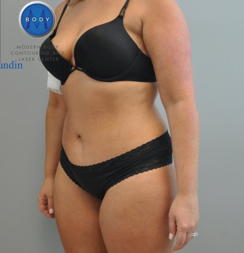 Tummy Tuck Before and After | Little Lipo
