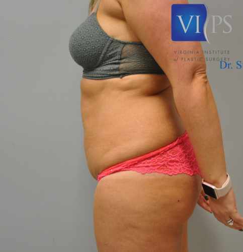 Tummy Tuck Before and After | Little Lipo