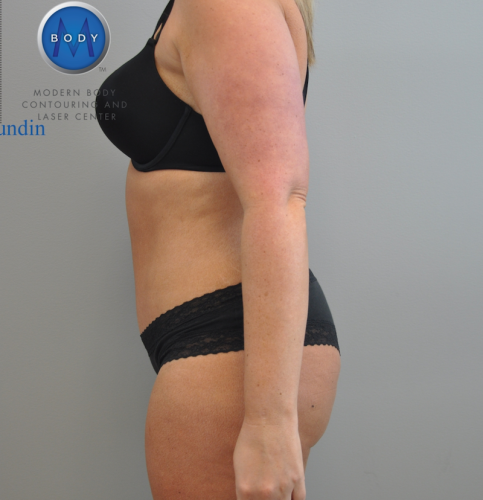 Tummy Tuck Before and After | Little Lipo