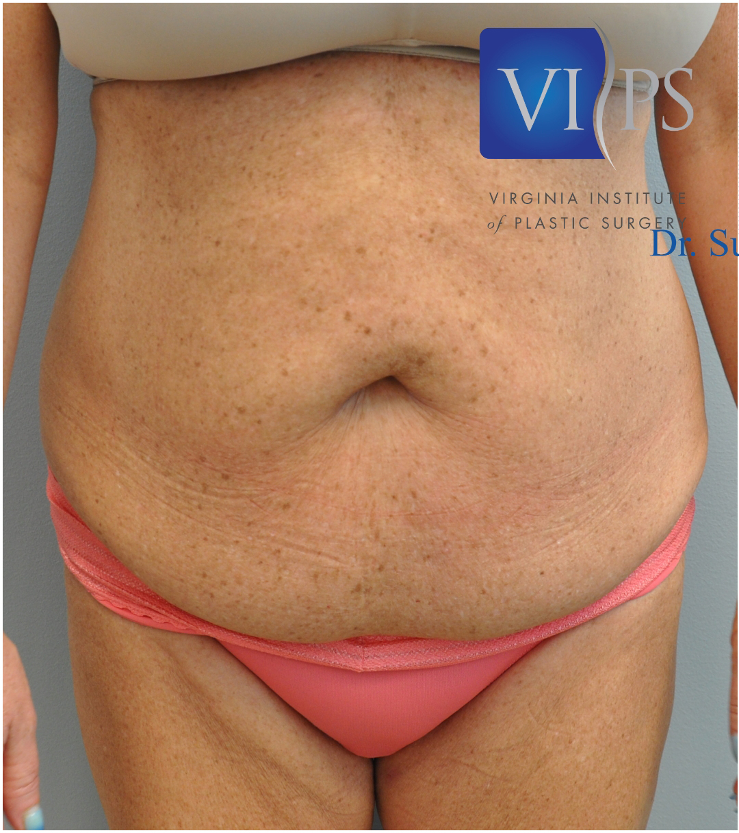 Tummy Tuck Before and After | Little Lipo