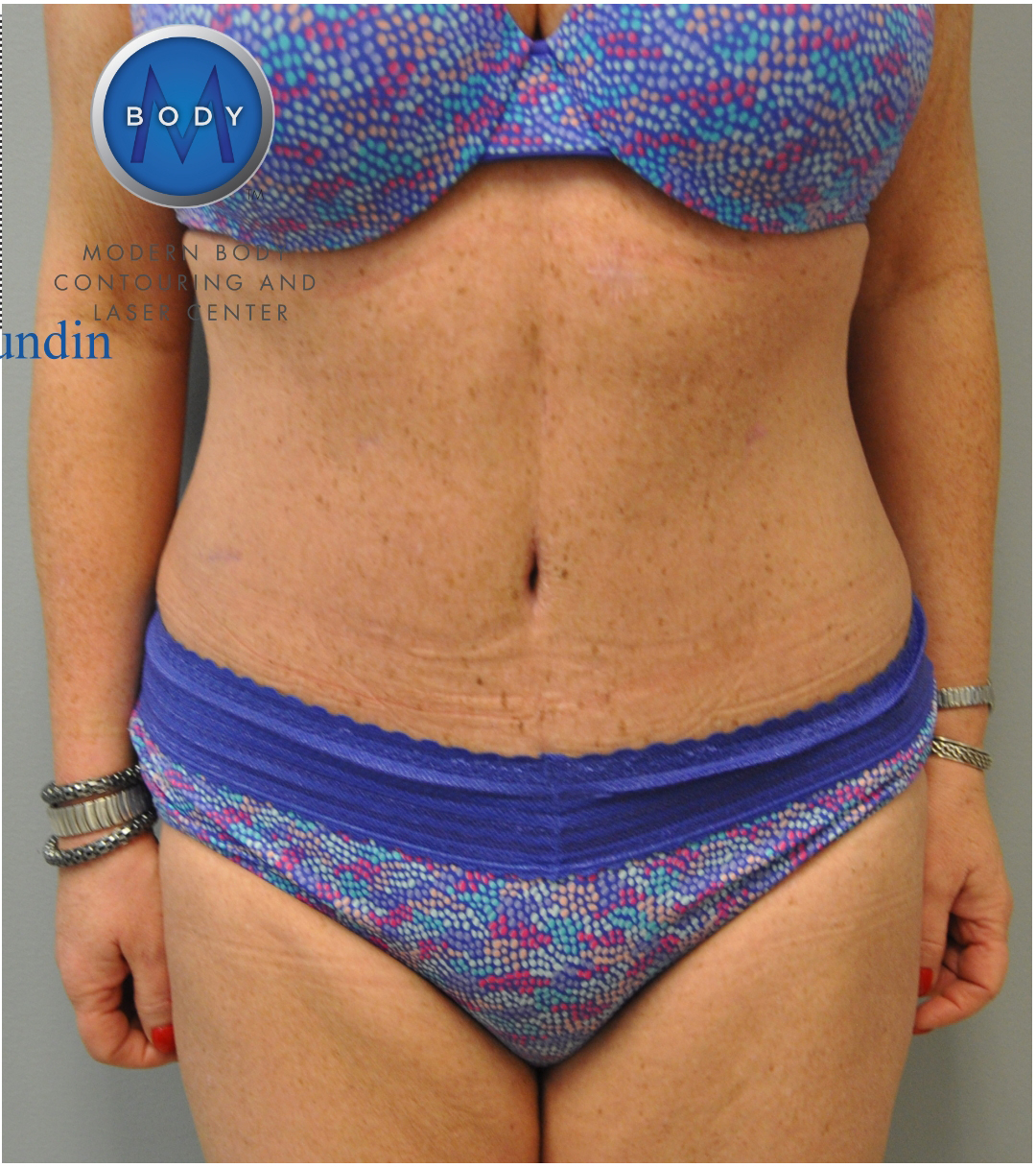 Tummy Tuck Before and After | Little Lipo