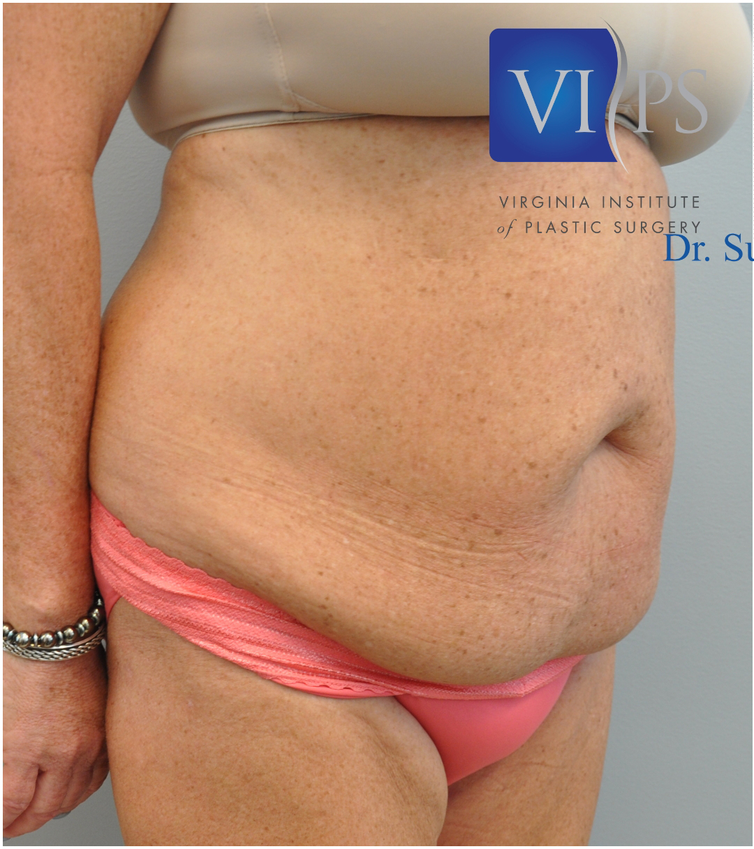 Tummy Tuck Before and After | Little Lipo