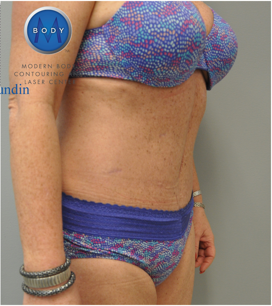 Tummy Tuck Before and After | Little Lipo