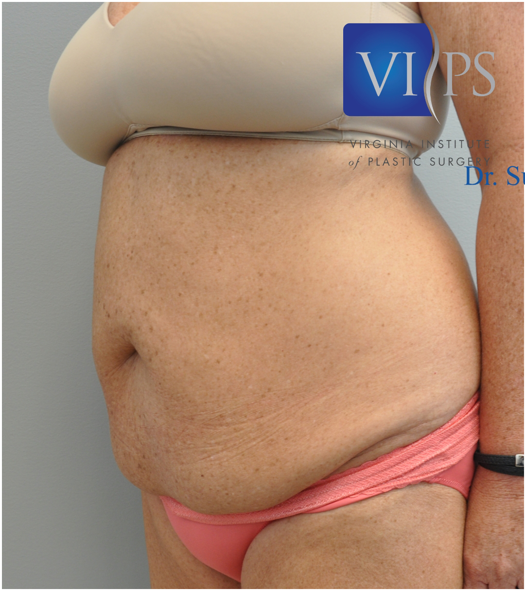 Tummy Tuck Before and After | Little Lipo