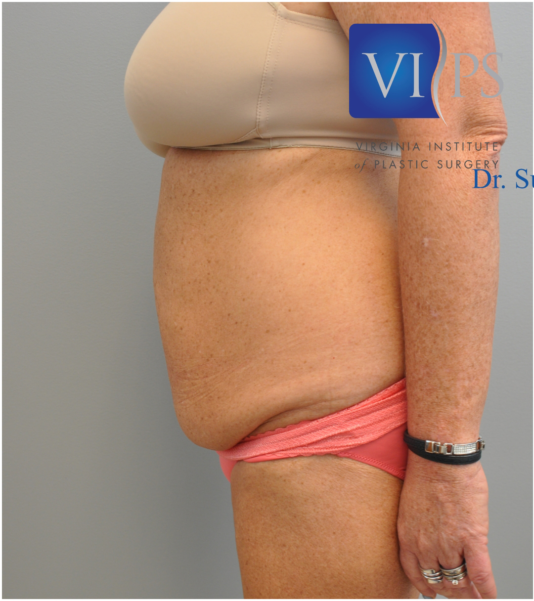 Tummy Tuck Before and After | Little Lipo