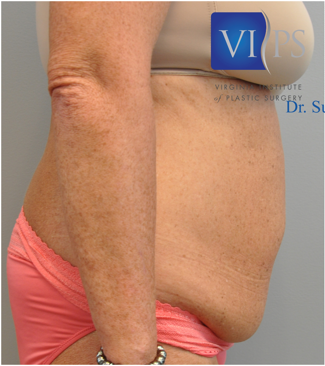 Tummy Tuck Before and After | Little Lipo