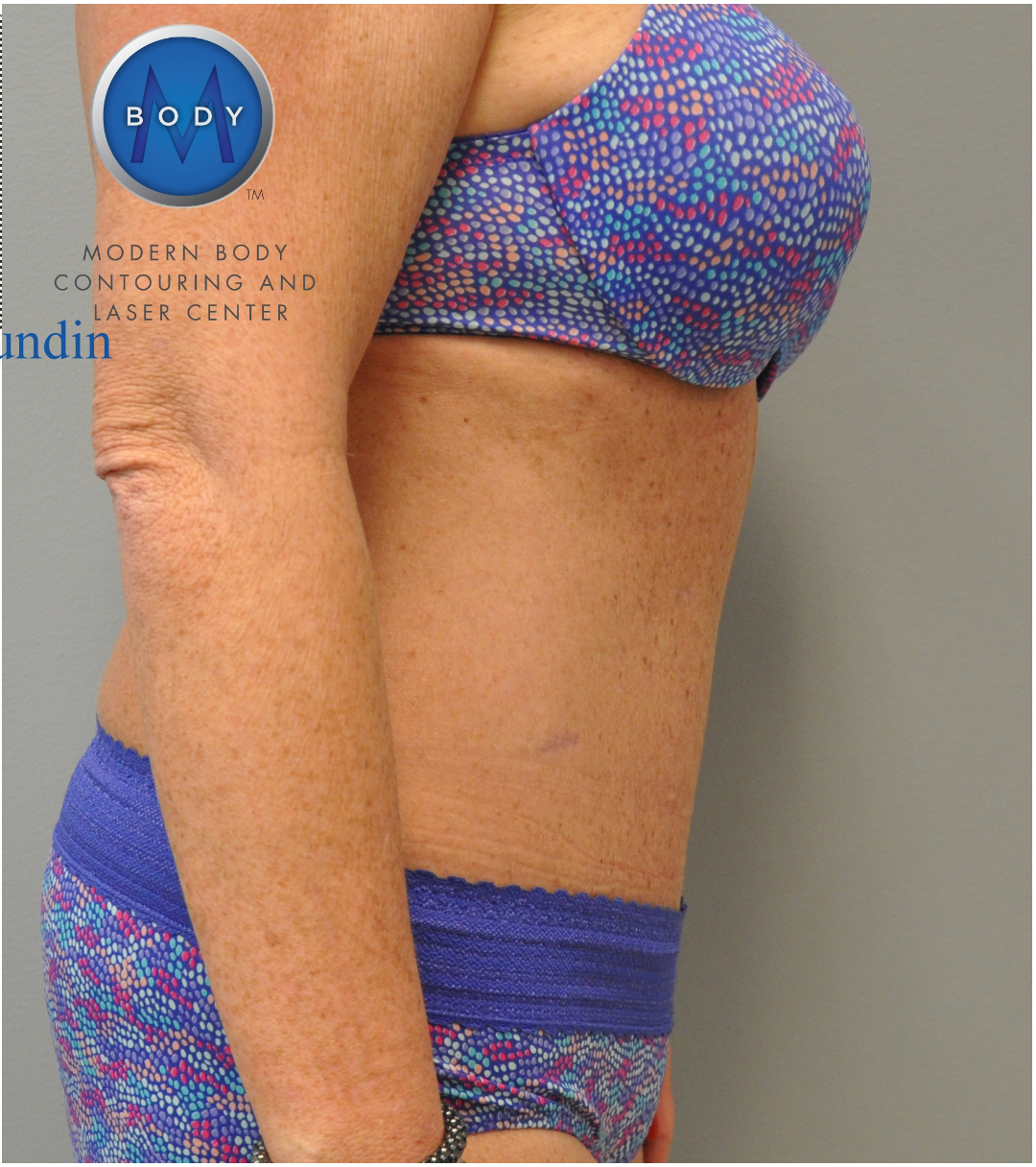 Tummy Tuck Before and After | Little Lipo