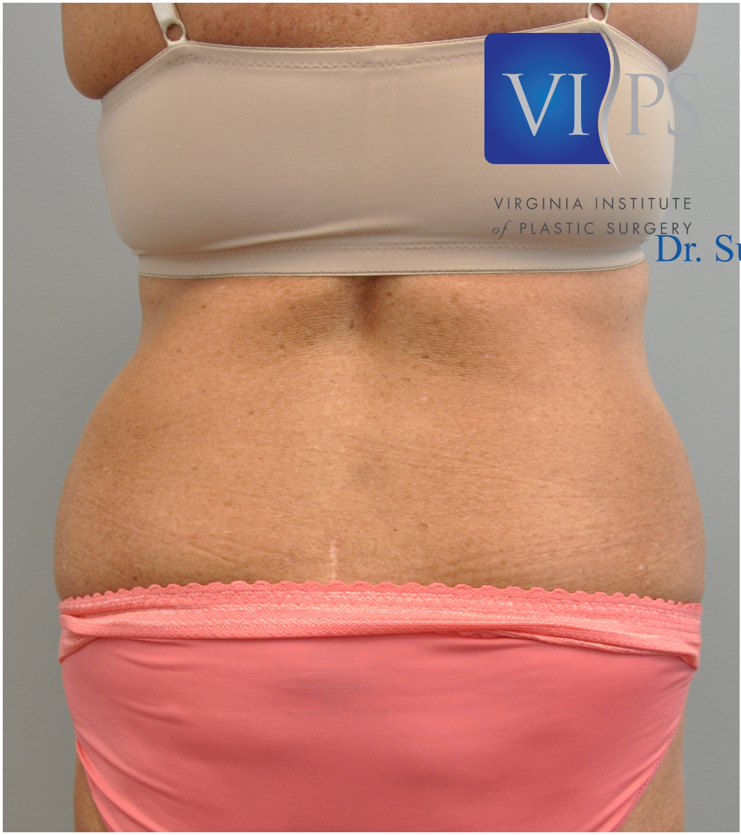 Tummy Tuck Before and After | Little Lipo
