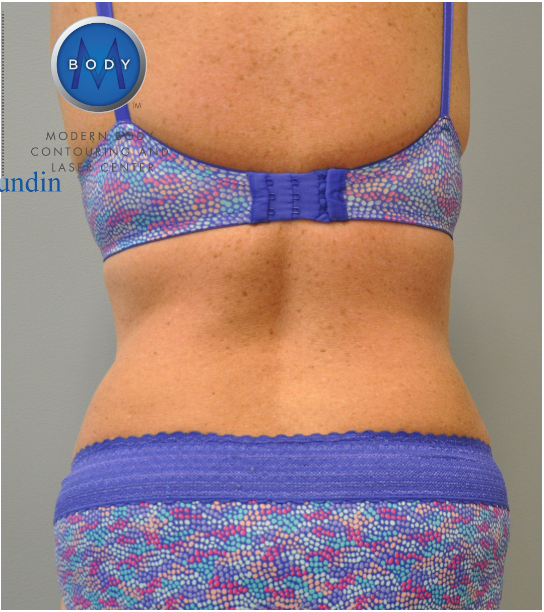 Tummy Tuck Before and After | Little Lipo
