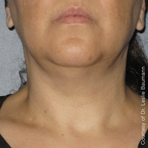 Ultherapy Before and After | Little Lipo