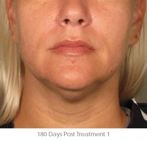 Ultherapy Before and After | Little Lipo