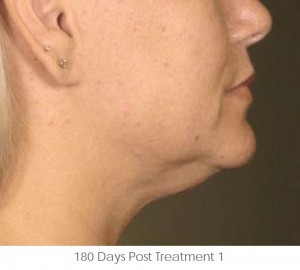 Ultherapy Before and After | Little Lipo