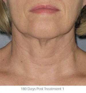 Ultherapy Before and After | Little Lipo