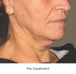 Ultherapy Before and After | Little Lipo