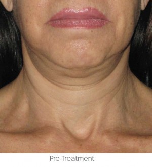 Ultherapy Before and After | Little Lipo