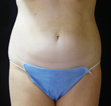 Ultrashape Before and After | Little Lipo