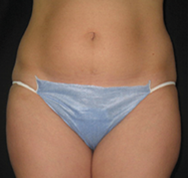 Ultrashape Before and After | Little Lipo