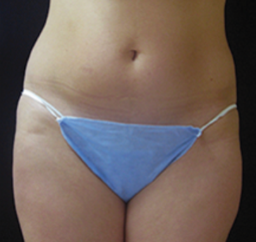 Ultrashape Before and After | Little Lipo